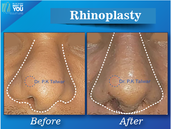 rhinoplasty surgery result